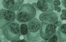 MY13 study multiple myeloma MY13 study multiple myeloma